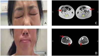 A novel variant of COL6A3 c.6817-2(IVS27)A>G causing Bethlem myopathy: A case report